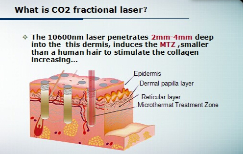 Лазер СО2 Эр700б профессиональный частичный для удаления меток простирания
